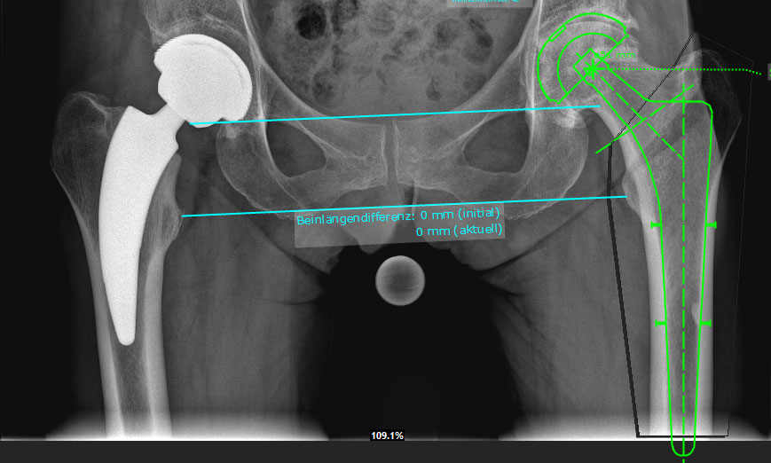 Röntgenbild einer zementfreien Kurzschaftprothese (links). Zum Vergleich die digitale Planung einer konventionellen Geradschaftprothese (rechts).