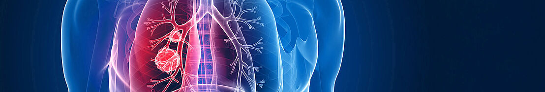 Lungenkrebs-Screening