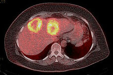 PET/CT-Aufnahme der Leber