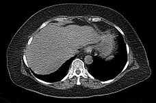 CT-Aufnahme der Leber