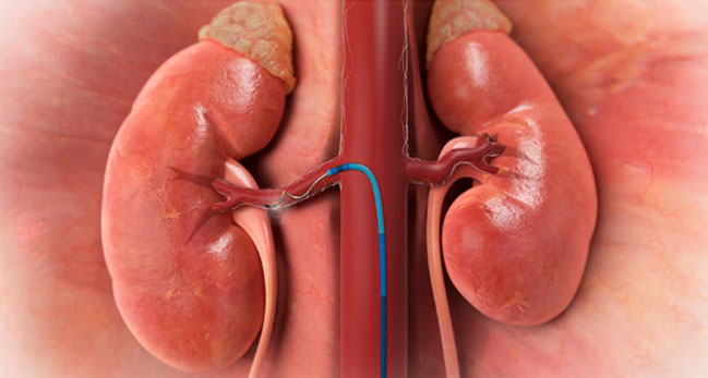 Renale Denervation gegen Bluthochdruck Grafische Darstellung der beiden Nieren; in eine Nierenarterie wurde ein spezieller Katheter eingeführt.