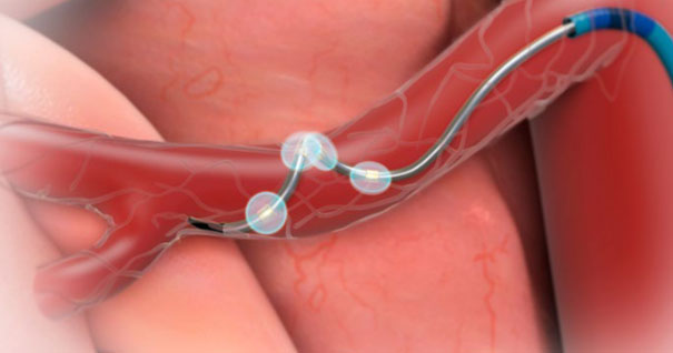 Renale Denervation Renale Denervation: Ein spezieller Katheter liegt in der Nierenarterie