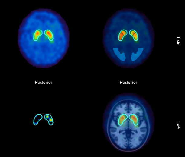 Dopamin-Rezeptor-Szintigrafie DATSCAN in der Nuklearmedizin: Frage nach Morbus Parkinson, essentieller Tremor